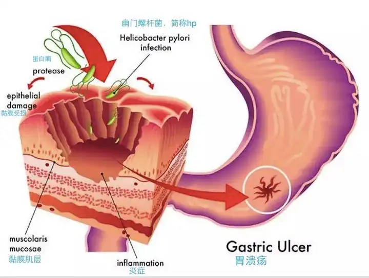 Speed and chronic gastritis, gastric ulcers