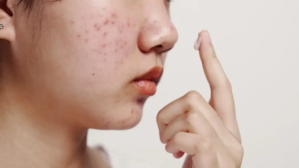 Treating Acne