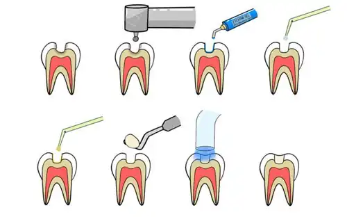 dental adhesive 01