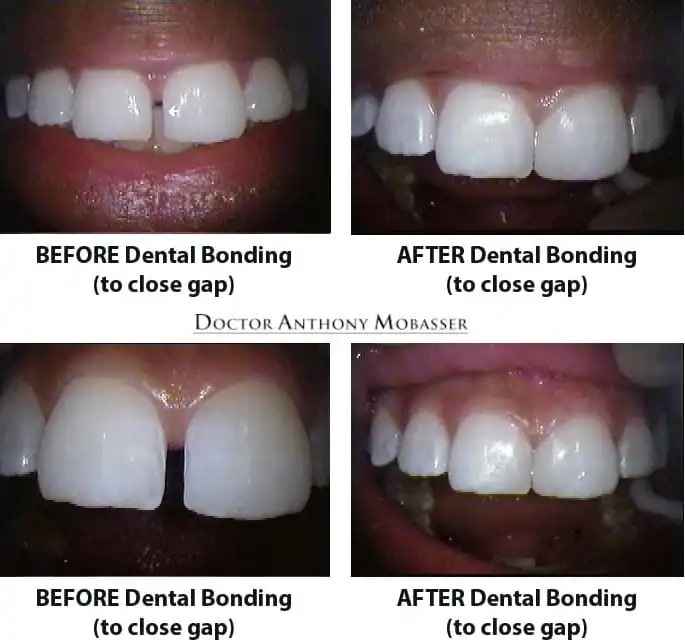 dental adhesive 02