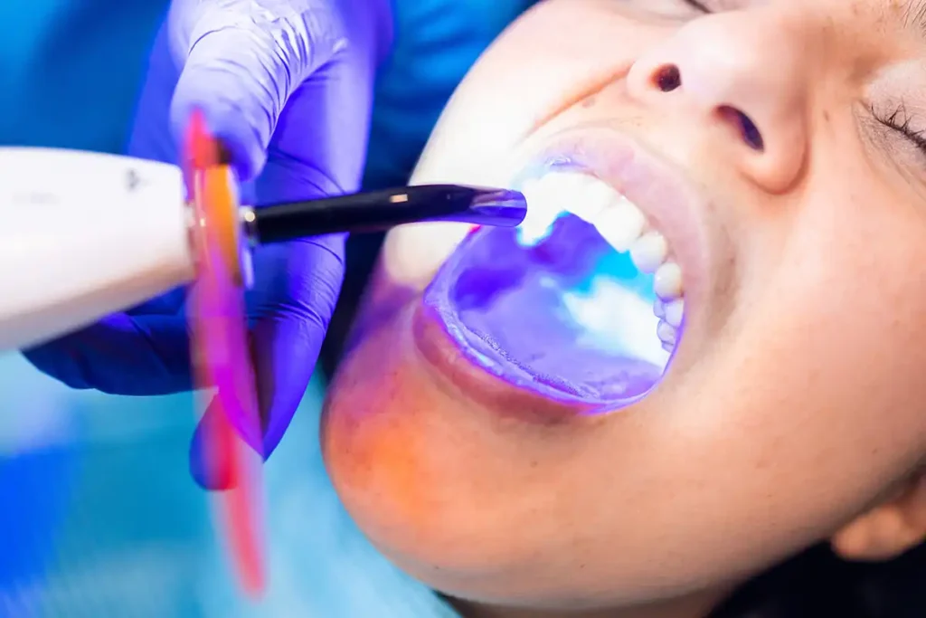 dental resin composite restorations